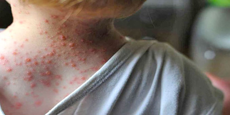 Dentro de la población en general, los niños son los más susceptibles de ser infectados por el virus.