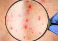 La viruela del simio presenta una erupción perecida a la de la varicela.