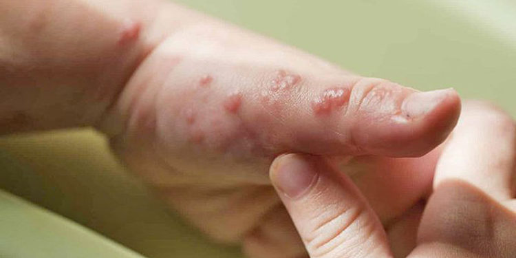 El contagio de la viruela del mono es muy bajo, pero hay que estar alerta.