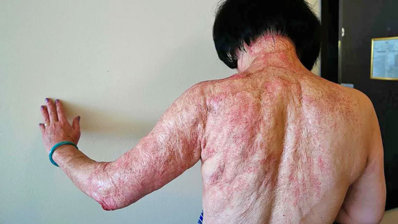 El cuerpo de Kim Phuc tuvo que ser sometido a diecisiete operaciones de injertos de piel. Foto: cortesía Nick Ut/AP Photo.