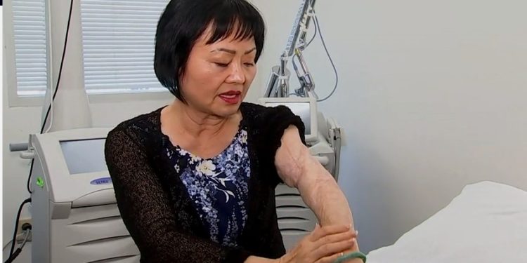 50 años después : ‘Niña del napalm’ recibe tratamiento por quemaduras en Florida