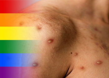 La viruela del mono no es exclusiva de personas homosexuales, pero es el grupo poblacional con mayor riesgo de contagio.