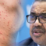 Director de la OMS, Tedros Adhanom, toma decisiones con más lentitud, que la rapidez con la que aumentan casos de viruela del mono en el mundo.