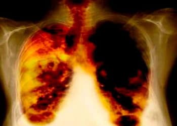 Descubren el talón de Aquiles por dónde atacar al cáncer de pulmón.