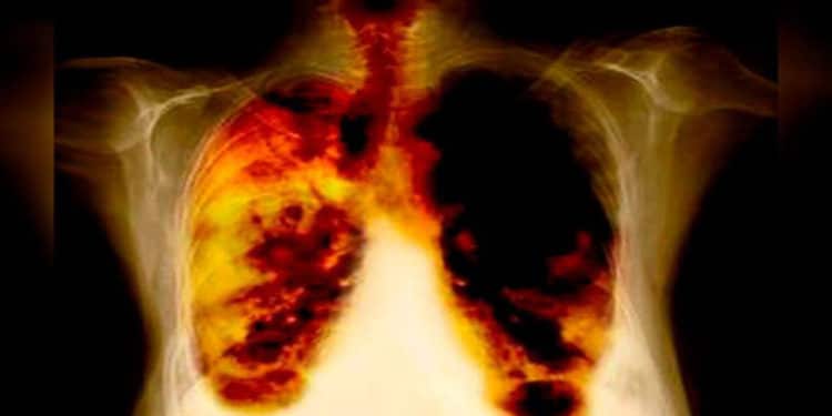 Descubren el talón de Aquiles por dónde atacar al cáncer de pulmón.